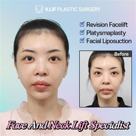 vlif plastic surgery korea